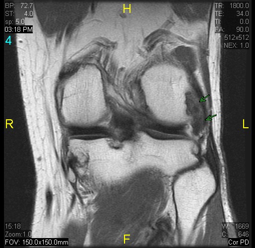 Figure 8 for case gout arthritis ( RID3567 )